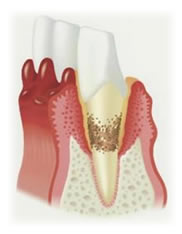歯周病予防